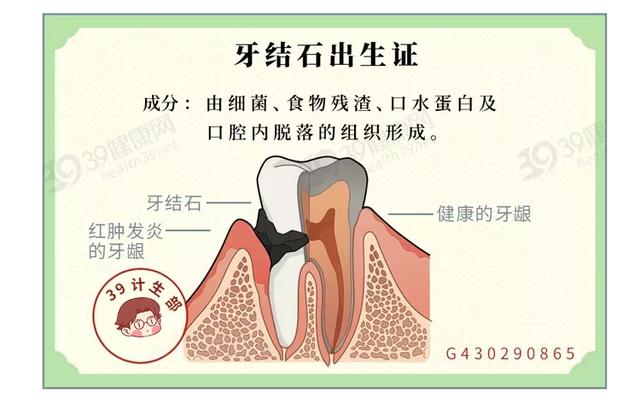 去除牙石简单的方法？教你去除牙石的3种方法