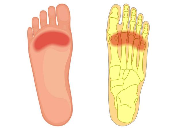 右脚底疼痛部位图解,右脚右脚底疼痛部位图解